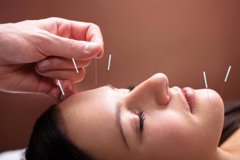 Acupuncture in Hollywood FL Acupuncture in Hollywood FL