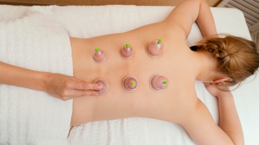 Expert Cupping Therapy in Eastleigh